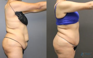 Before and after Abdominoplasty case 19849 - Angle 2