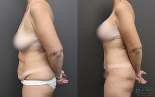 Before and after Abdominoplasty case 19850 - Angle 2