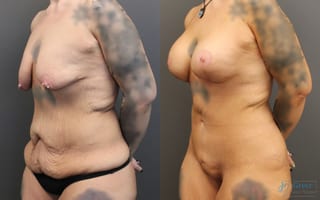 Before and after Breast Augmentation case 19852 - Angle 2