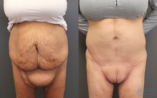 Before and after Monsplasty case 19853 - Angle 1