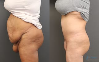 Before and after Monsplasty case 19853 - Angle 2