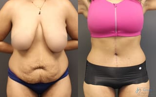 Before and after Fleur-de-Lis Abdominoplasty case 19858 - Angle 1