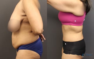 Before and after Fleur-de-Lis Abdominoplasty case 19858 - Angle 2