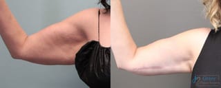Before and after Brachioplasty case 19860 - Angle 1