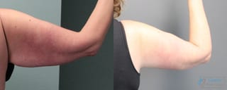 Before and after Brachioplasty case 19860 - Angle 2