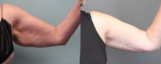 Before and after Brachioplasty case 19860 - Angle 3