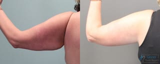 Before and after Brachioplasty case 19860 - Angle 4
