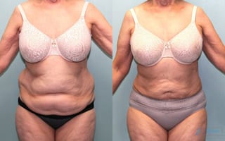 Before and after Liposuction case 19866 - Angle 1