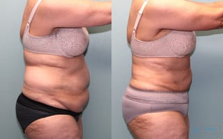 Before and after Liposuction case 19866 - Angle 2