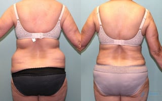 Before and after Liposuction case 19866 - Angle 3