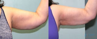 Before and after Liposuction case 19868 - Angle 3