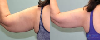 Before and after Liposuction case 19868 - Angle 4