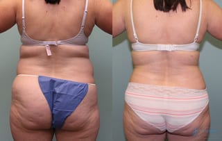Before and after Liposuction case 19869 - Angle 2