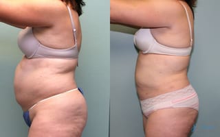 Before and after Liposuction case 19869 - Angle 3