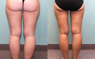 Before and after Liposuction case 19870 - Angle 2