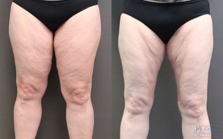 Before and after Liposuction case 19871 - Angle 1