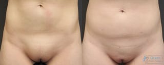 Before and after Monsplasty case 19872 - Angle 1