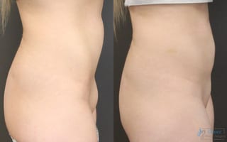 Before and after Monsplasty case 19872 - Angle 2