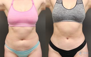 Before and after Liposuction case 19875 - Angle 1