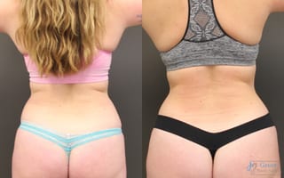 Before and after Liposuction case 19875 - Angle 2