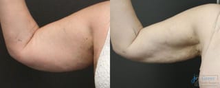 Before and after Liposuction case 19876 - Angle 1