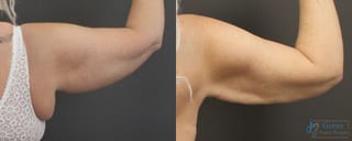 Before and after Liposuction case 19876 - Angle 2