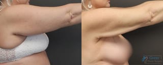 Before and after Liposuction case 19876 - Angle 3