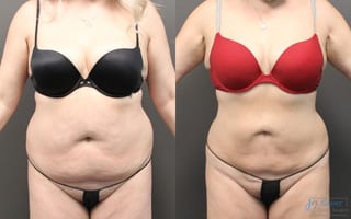 Before and after Liposuction case 19878 - Angle 1