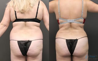 Before and after Liposuction case 19878 - Angle 2