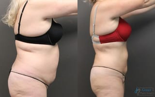 Before and after Liposuction case 19878 - Angle 3