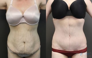 Before and after Tummy Tuck case 19907 - Angle 1