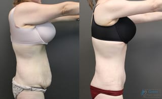 Before and after Tummy Tuck case 19907 - Angle 2