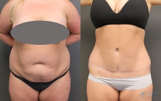Before and after Abdominoplasty case 19843 - Angle 1