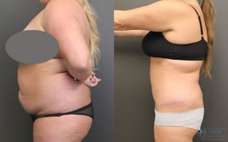 Before and after Abdominoplasty case 19843 - Angle 2