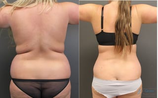 Before and after Abdominoplasty case 19843 - Angle 3