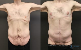 Before and after Tummy Tuck case 23996 - Angle 1