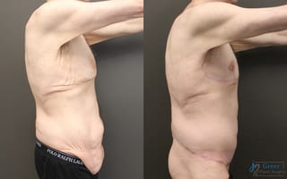 Before and after Tummy Tuck case 23996 - Angle 2