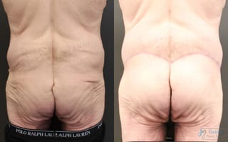 Before and after Tummy Tuck case 23996 - Angle 3
