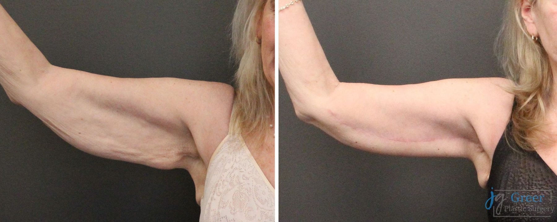 Before and after Thigh Lift case 41340