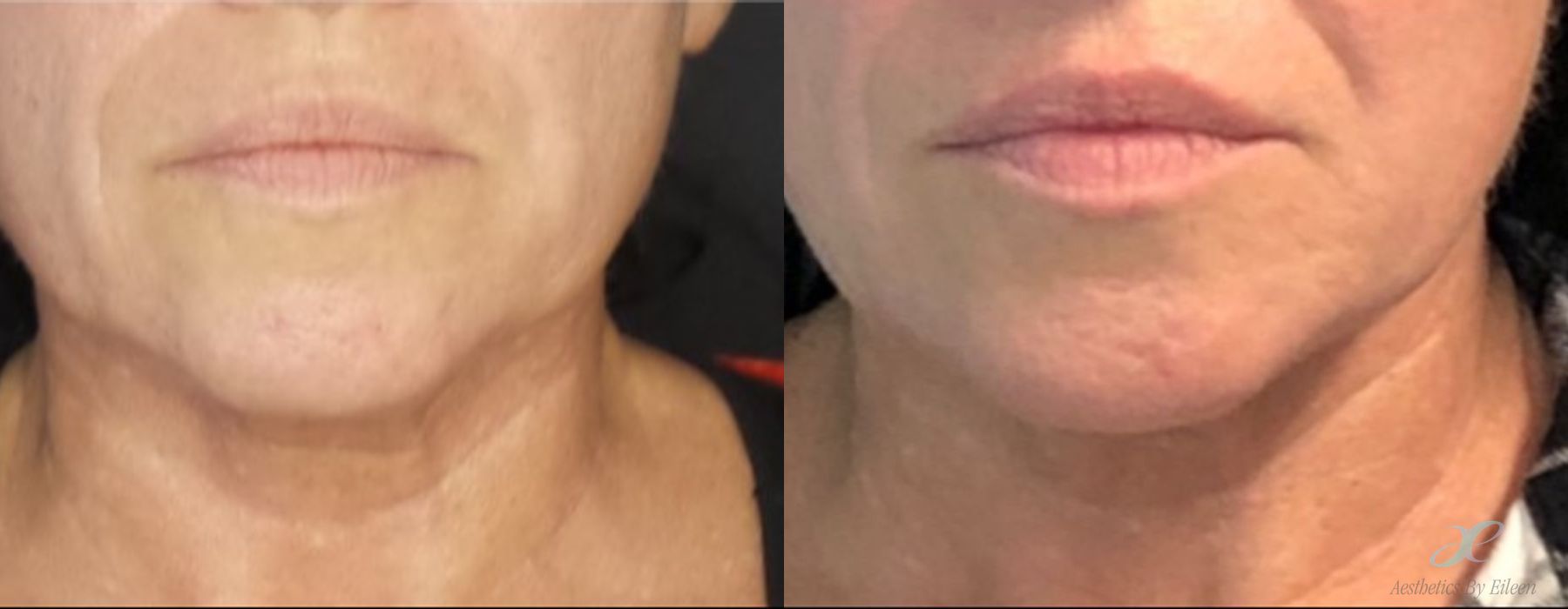 BOTOX Cosmetic - Case 10139