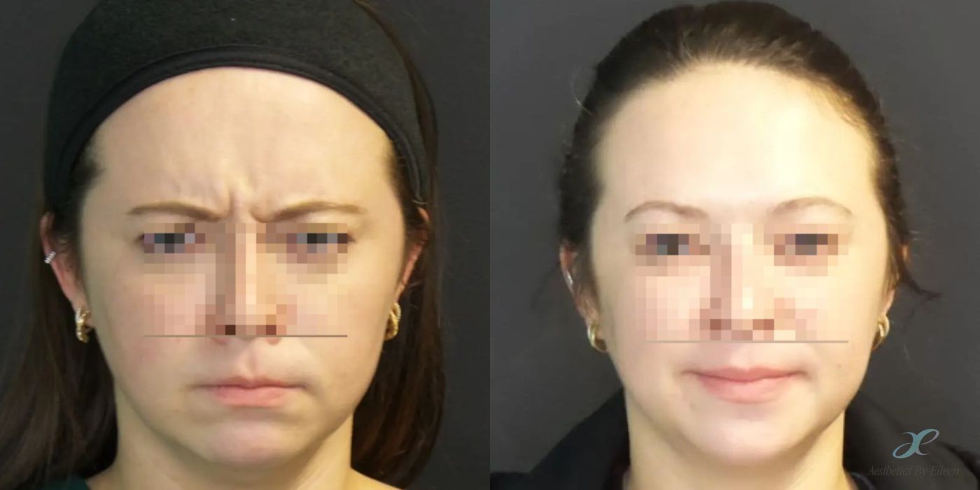 BOTOX Cosmetic - Case 10142