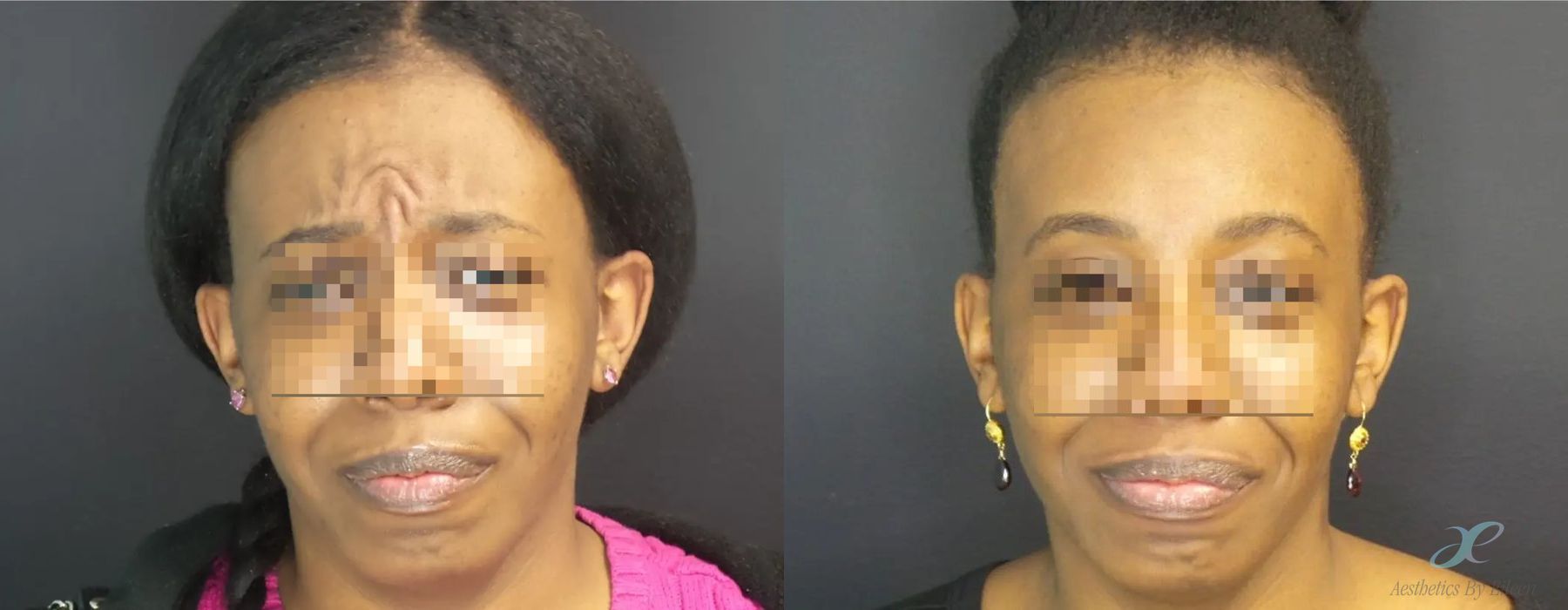 BOTOX Cosmetic - Case 10141