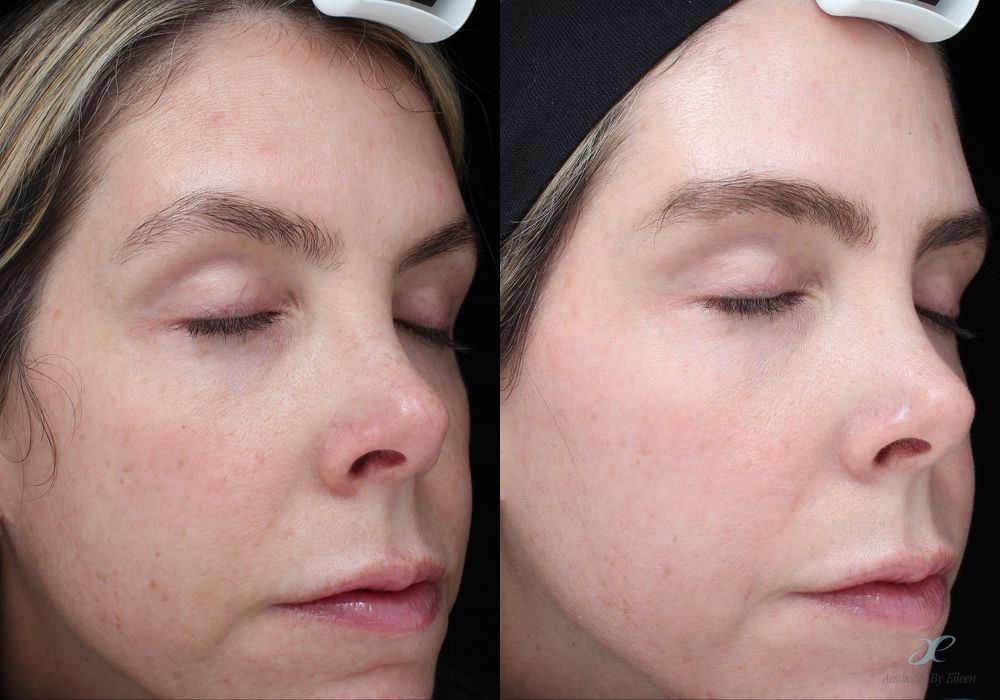 BOTOX Cosmetic - Case 10140