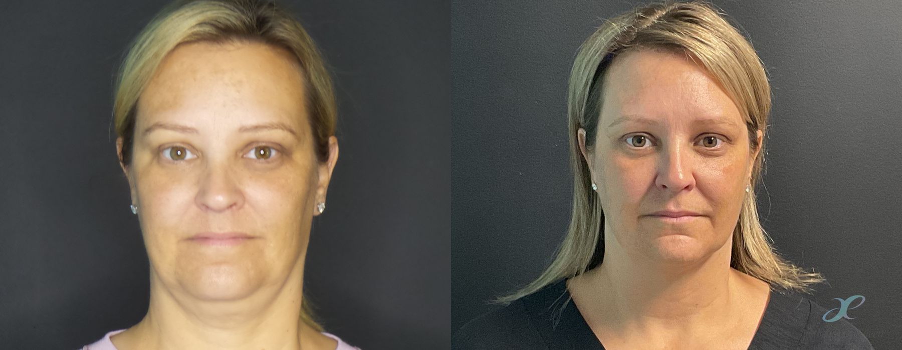 Non-surgical Body Sculpting - Case 10063