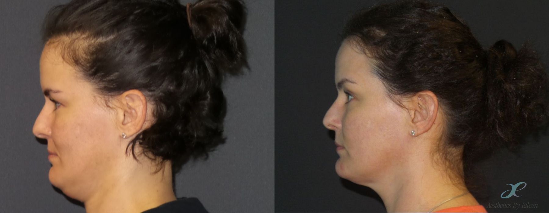 Double Chin - Kybella - Case 10080