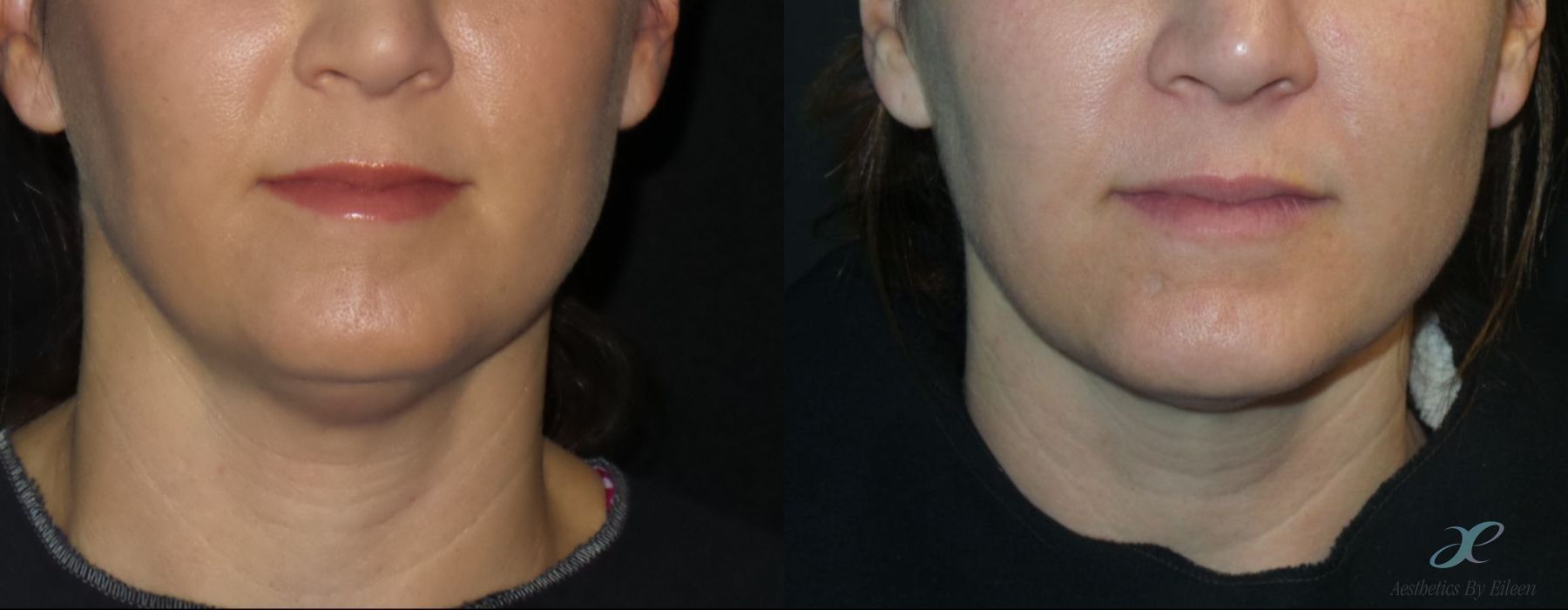 Double Chin - Kybella - Case 10076