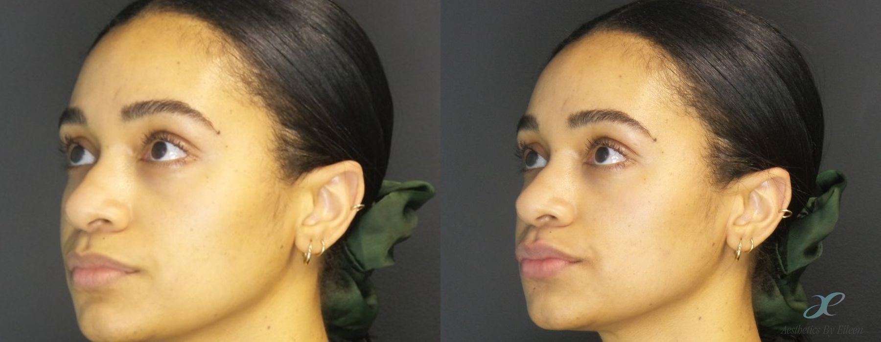 Fillers - Case 10104