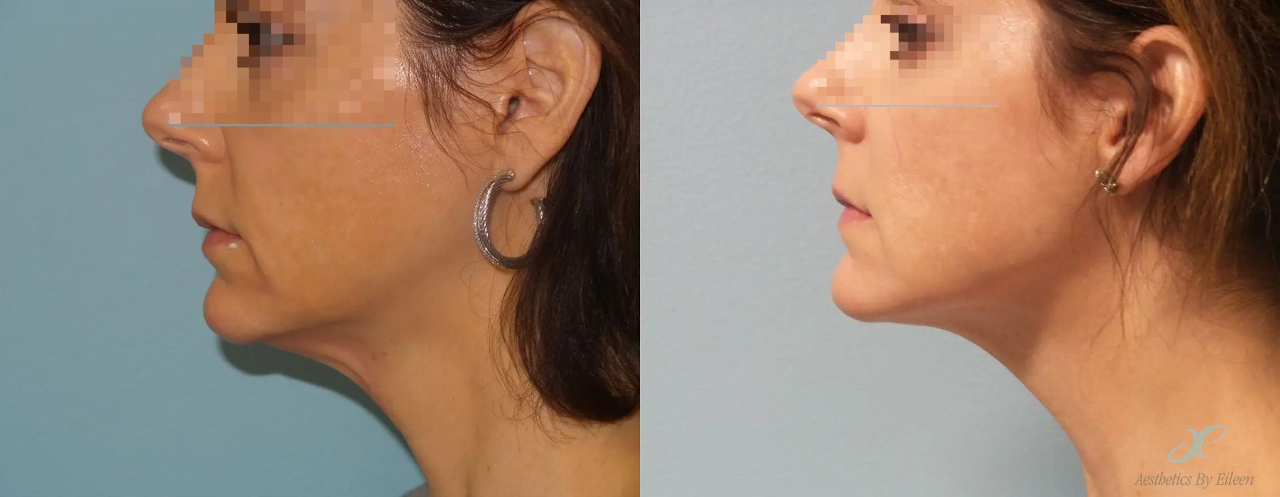 Before and after procedure result