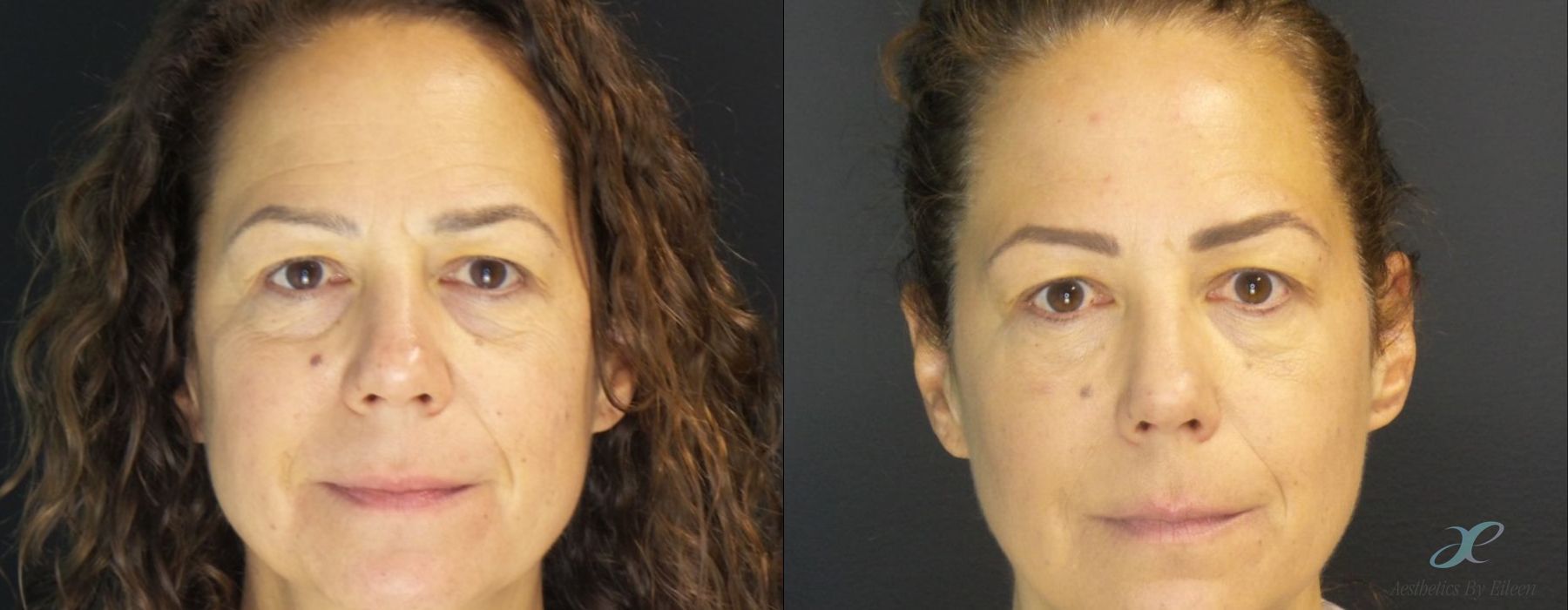 Before and after procedure result