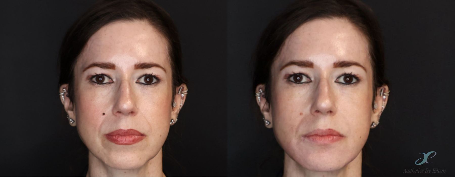 Before and after procedure result